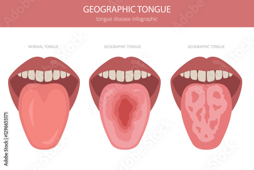 Geographic tongue disease. Oral medicine. Medical infographic design. Vector illustration