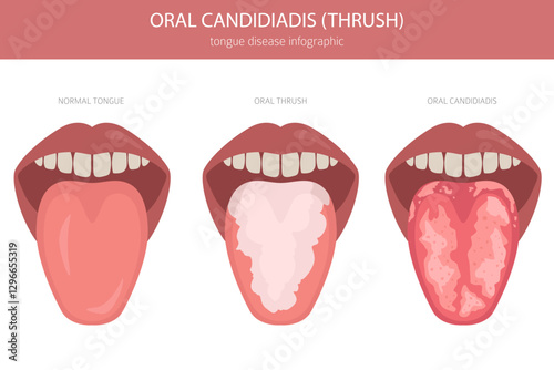 Oral thrush. Oral candidiadis disease. Medical infographic design. Vector illustration