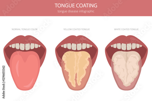 Tongue coating. Oral medicine. White tongue, yellow coated tongue disease. Medical infographic design. Vector illustration