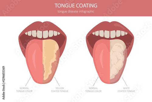 Tongue coating. Oral medicine. White tongue, yellow coated tongue disease. Medical infographic design. Vector illustration