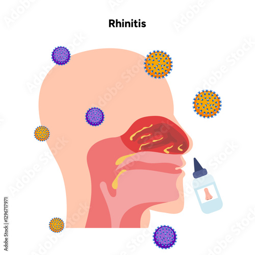 Nose Nasal diseases. Rhinitis symptoms. Allergy, rhinitis, cold medical diagram with viruses and nasal spray