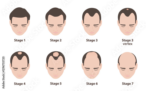 Infographic of the norwood scale for male pattern baldness illustration on white background. Androgenetic alopecia is a type of hair loss that affects men, seven stages of male pattern baldness.