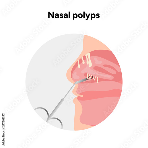 Nasal polyps, nose disease. Diagnostic and treatment. Medical diagram anatomy