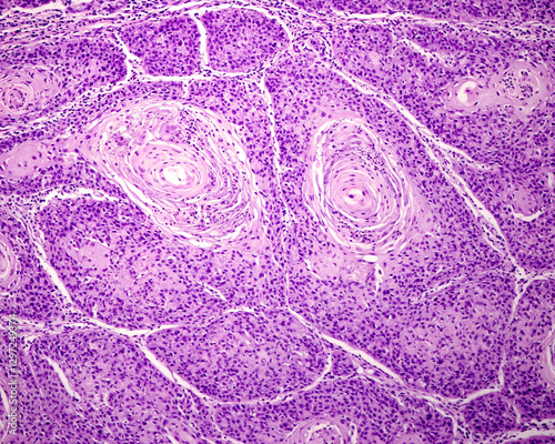 Human skin. Squamous cell carcinoma