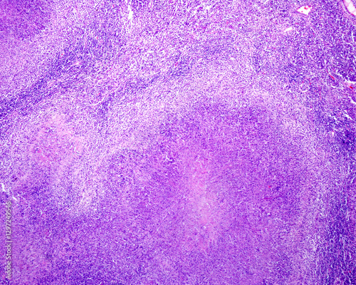 Human lymph node. Tuberculous lymphadenitis photo