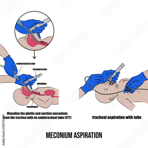 Meconium aspiration in newborns preparing for aspiration.