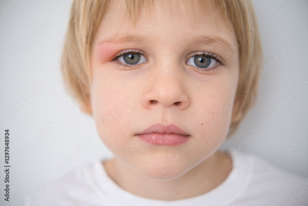 close up little boy with allergic red spot at eye cause by mosquito bite close up little boy with allergic red spot at eye cause by mosquito bite