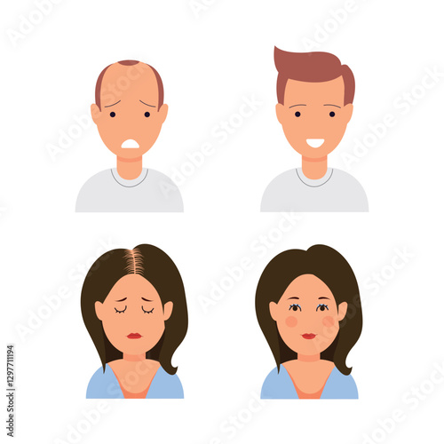 Human hair transplant. Woman and man before and after transplantation. Health care and medicine. Cartoon illustration, vector