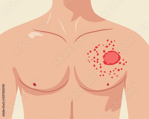 Medical illustration of a human chest with a skin rash, redness, and inflammation. Symptoms of skin infection, allergic reaction, or dermatological disease