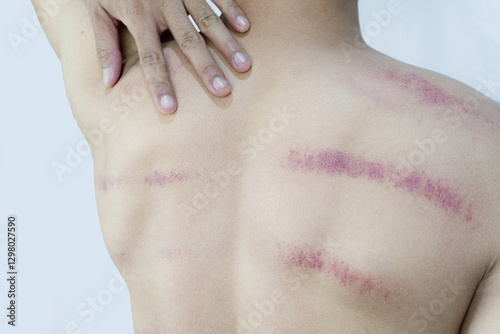 Back view of a man touching his shoulder, revealing lines of bruising and redness on his skin. Focus on healing or treatment process.