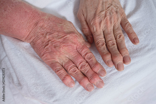 Tableau sur toile Arthritis of the fingers and capillary malformation on the female hand