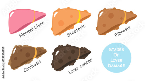 Stages of liver damage include steatosis or fatty liver, fibrosis, cirrhosis and cancer or hepatocellular carcinoma . Flat design . Vector .