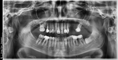 dental x-ray showing teeth and jaw structure. clear view of molars with dental work. important for assessing oral health and treatment needs.