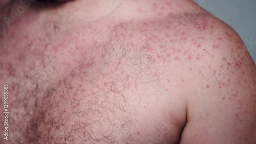 Serious problem of skin cancer in modern society, red small rashes on skin surface with itchy symptom, constant inflammation and irritation of epidermis, suspected skin cancer