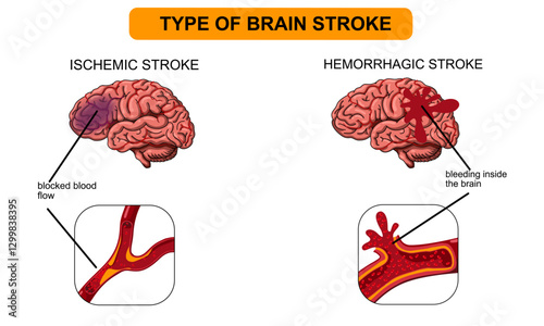 Brain stroke, hemorrhagic and ischemic. Arteriosclerosis, infarct, ischemia, thrombosis disease. Cholesterol in human blood vessels. Medical poster vector illustration.