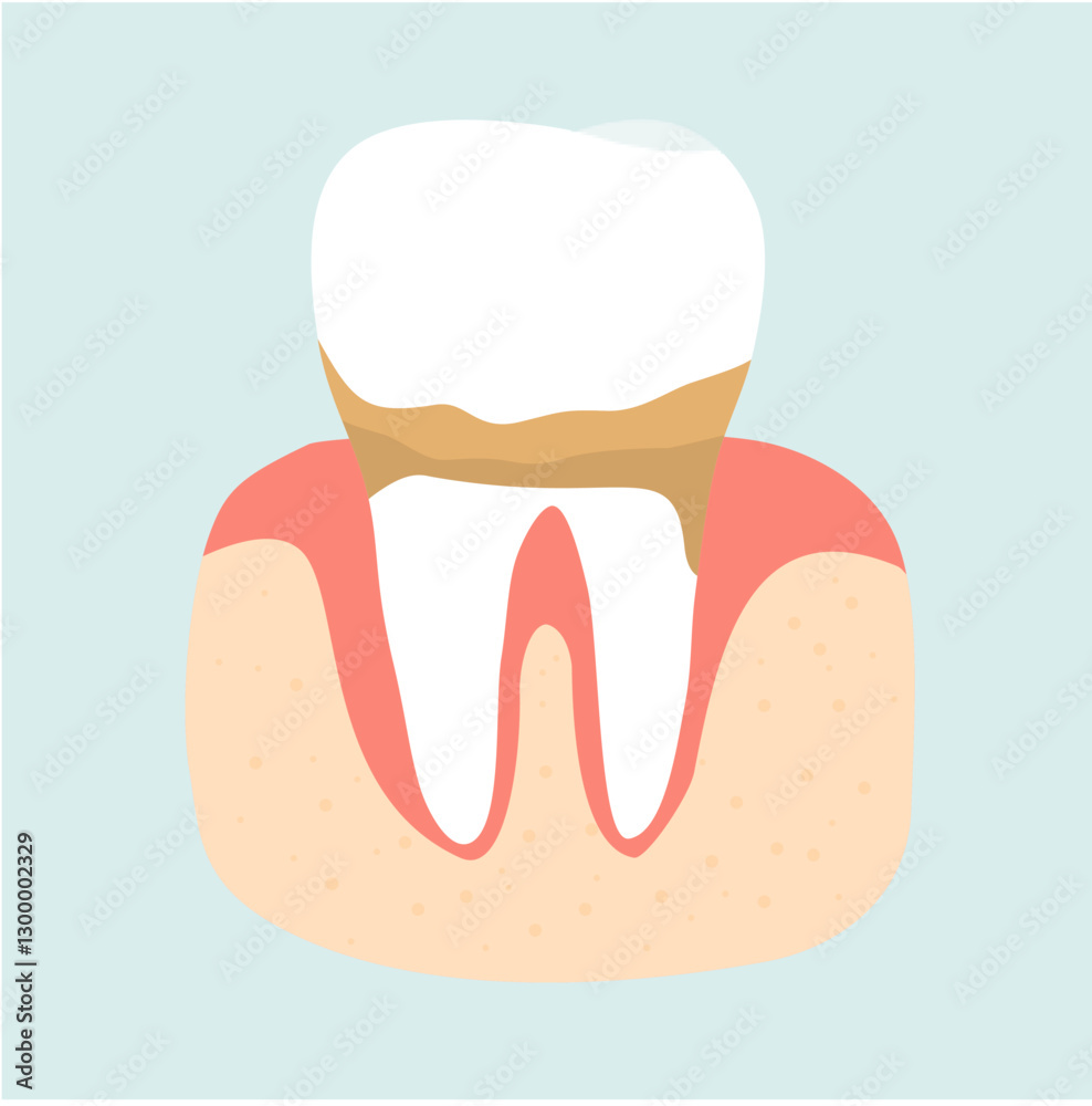Dental Plaque and Caries Tooth Problem. Dental Care Illustration Dental Plaque and Caries Tooth Problem. Dental Care Illustration