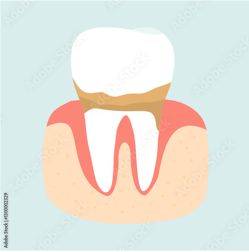 Dental Plaque and Caries Tooth Problem. Dental Care Illustration