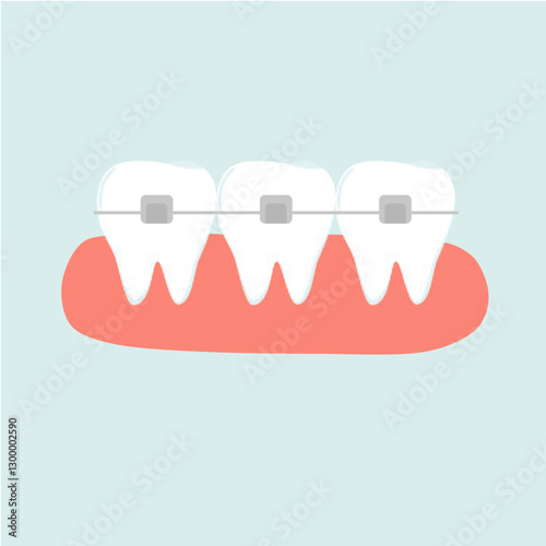 Orthodontic Self Ligating Braces Tooth Treatment. Dental Care Illustration