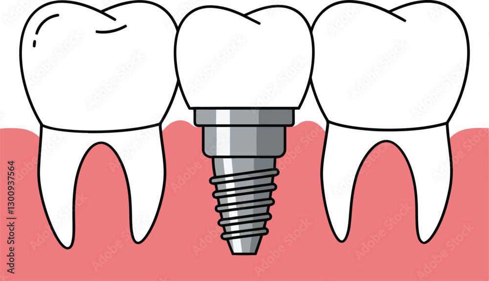 Detailed illustration of dental implants with neighboring teeth in a flat design style, showcasing oral health and dental technology in vector art