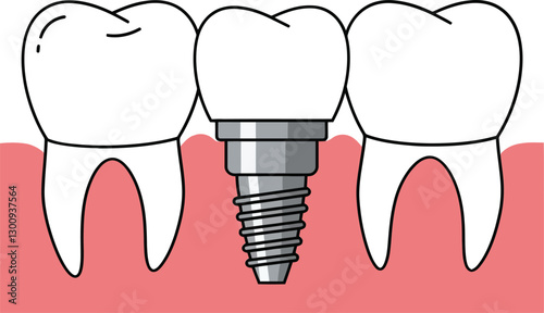Obraz na płótnie Detailed illustration of dental implants with neighboring teeth in a flat design style, showcasing oral health and dental technology in vector art w salonie