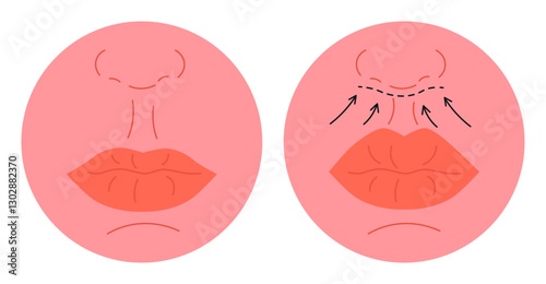 Lip Lift Surgery Before and After Illustration.