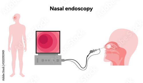 Nasal endoscopy procedure nasal and sinus passages. Thin, flexible tube with camera and light with monitor. Ear, nose, and throat. Medical diagram