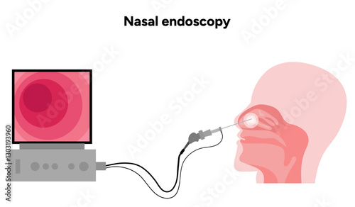 w414Nasal endoscopy procedure nasal and sinus passages. Thin, flexible tube with camera and light with monitor. Ear, nose, and throat. Medical diagram