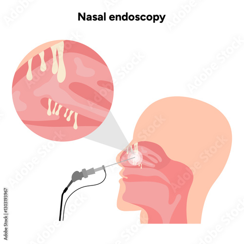 Nasal endoscopy procedure nasal and sinus passages. Thin, flexible tube with camera and light. Ear, nose, and throat. Medical diagram