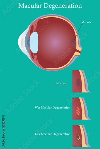 Age-related macular degeneration.Eye vision disorder on green background. vector eps 10