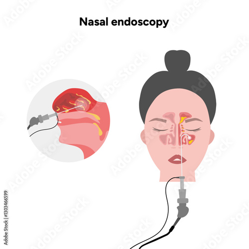 Nasal endoscopy procedure nasal and sinus passages. Thin, flexible tube with camera and light. Ear, nose, and throat. Medical diagram