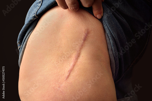 Total hip replacement, 40 months later, woman 60 photo