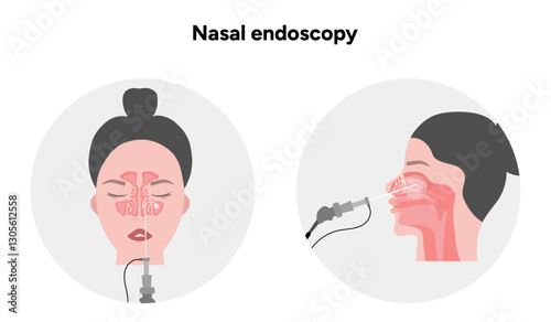 Nasal endoscopy procedure nasal and sinus passages. Thin, flexible tube with camera and light. Ear, nose, and throat. Medical diagram