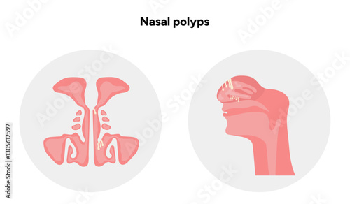 Nasal polyps, nose disease. Diagnostic and treatment. Medical diagram anatomy