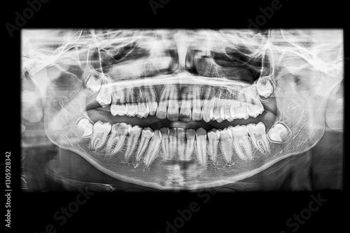 Dental panoramic x-ray of a teenager showing a decayed lower molar. The radiograph reveals dental development and eruption issues of the wisdom teeth that are still in bud stage