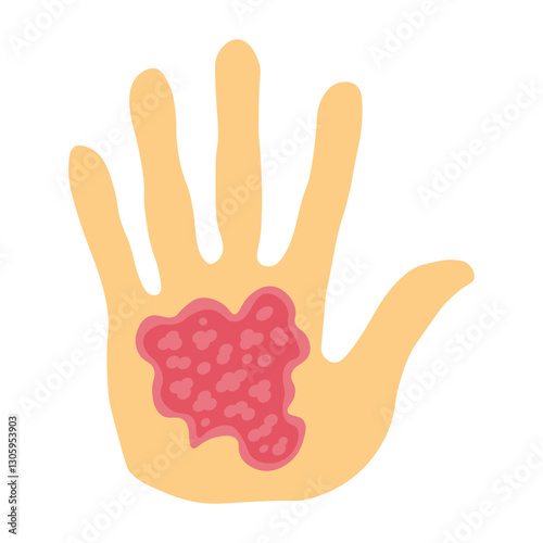 Eczema