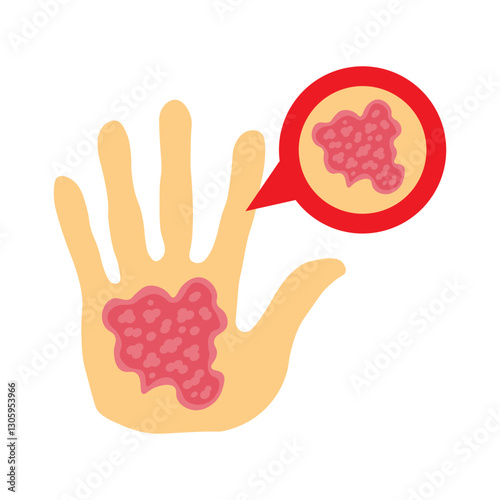 Eczema 