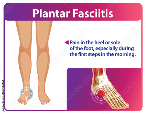 Understanding Plantar Fasciitis Pain Relief