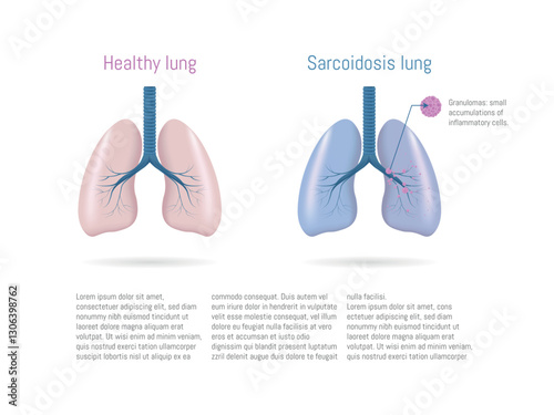 Sarcoidosis affecting human lungs, showing granulomas and inflammation