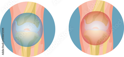 Hemarthrosis of the knee is bleeding into the knee joint, causing pain, swelling, and restricted movement