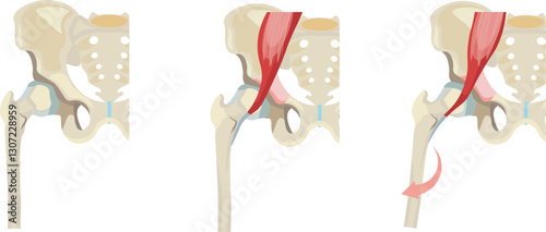 Snapping hip syndrom internal type