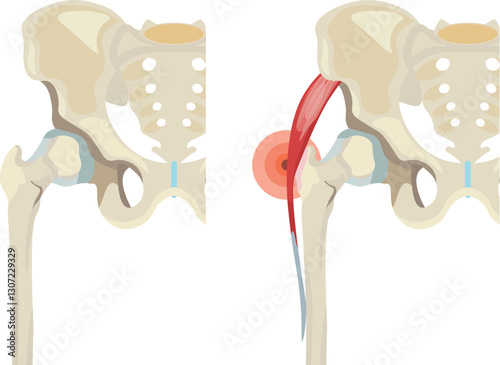 Snapping hip syndrom external type