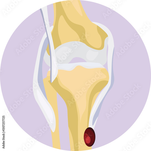 pes anserine bursitis knee pain vector 