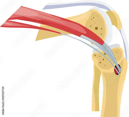 pes anserine bursitis knee pain vector 