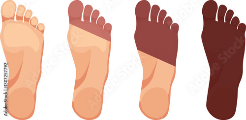 stages of ischaemic foot vector 