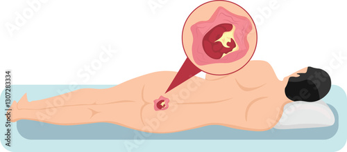 Pressure ulcers formation on bony parts of the body, such as the heels, elbows, hips and tailbone