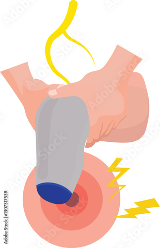 phantom limb is chronic condition that causes a person to feel as if an amputated limb is still attached
