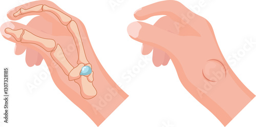 Ganglion cysts where lumps containing jelly like fluid develop in the wrist
