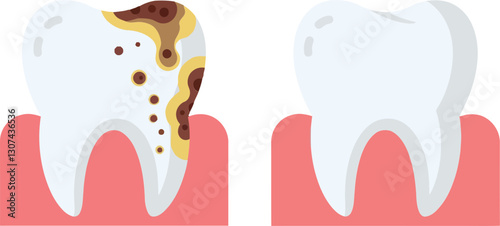 Two dental illustrations showcasing a healthy tooth alongside a decayed tooth in a flat design style, emphasizing dental health and hygiene in vector art