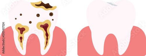 Detailed vector illustration of a decayed tooth alongside a healthy tooth showcasing dental health education in a minimal design style vector art