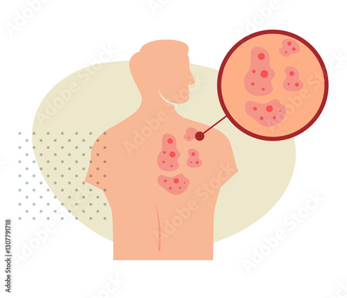 Raised Skin bumps and Patches on Back Body - Stock Illustration